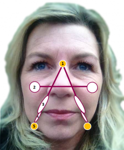 Aurora Lift points for facial rejuvenation