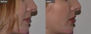 Cosmetic Courses; Image showing Lip Fillere treatment before & after