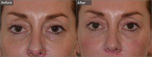 Cosmetic Courses;Picture showing Tear Trough Treatment Before & After