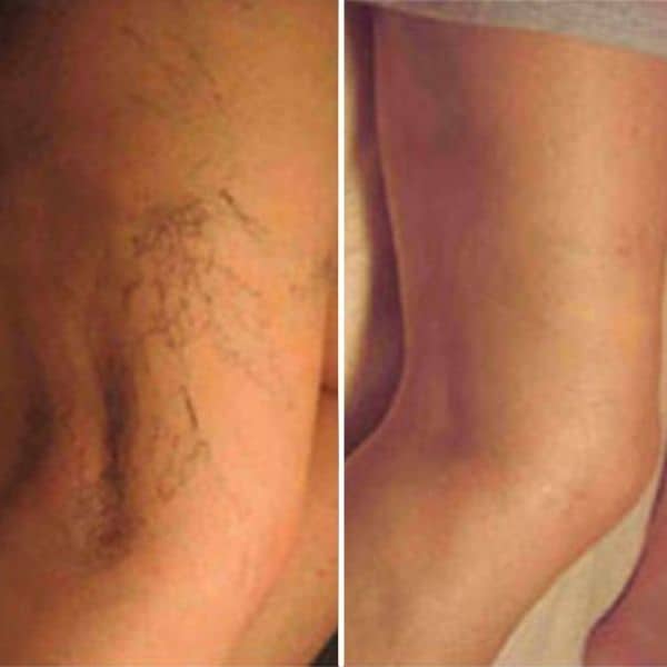 leg thread vein removal before and after cosmetic courses