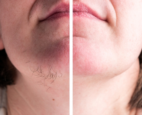 chin laser hair removal