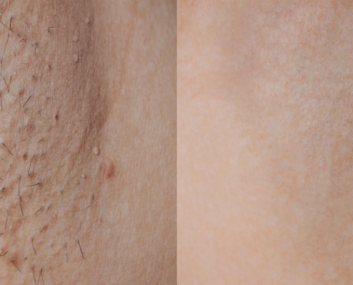 underarm laser hair removal