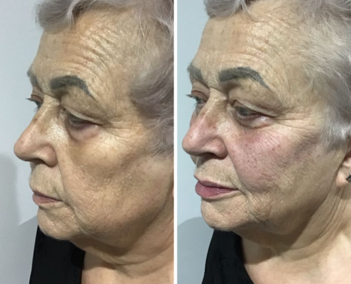 Non Surgical Face Lift Before & After 7