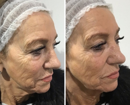 Non Surgical Face Lift Before & After 1