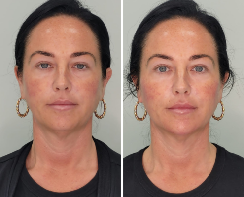 Non Surgical Face Lift Before & After 2