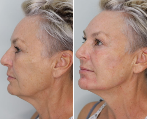 Non Surgical Face Lift Before & After 3