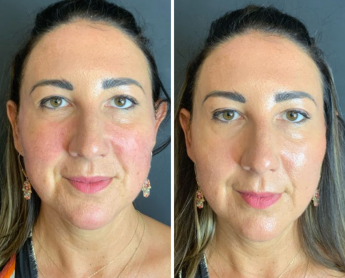 Non Surgical Face Lift Before & After 6